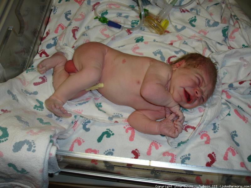 Umbilical Gone